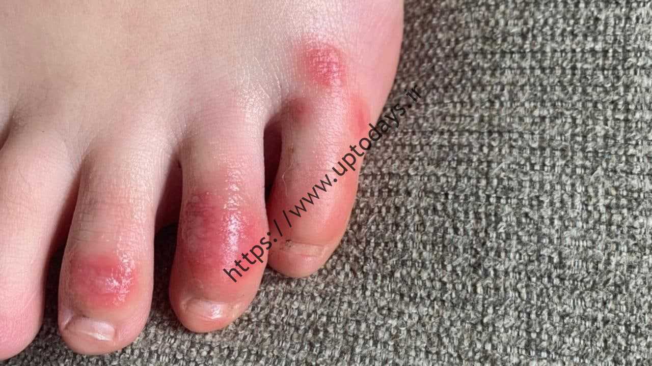 شش نشانه نادیده گرفته شدن پوست Omicron